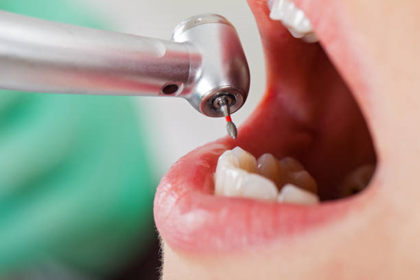 Best Emergency Wisdom Tooth Extraction in Harvey, ND